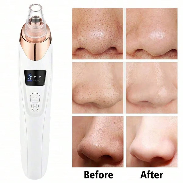 Electric Pore Cleaner &amp; Blackhead Remover